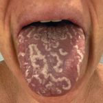 pictures of geographic tongue