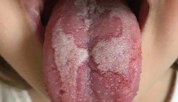 pictures of geographic tongue