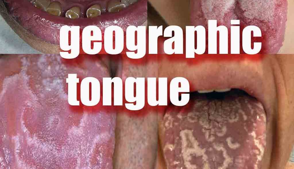 geographic tongue Signs