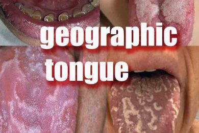 geographic tongue Signs